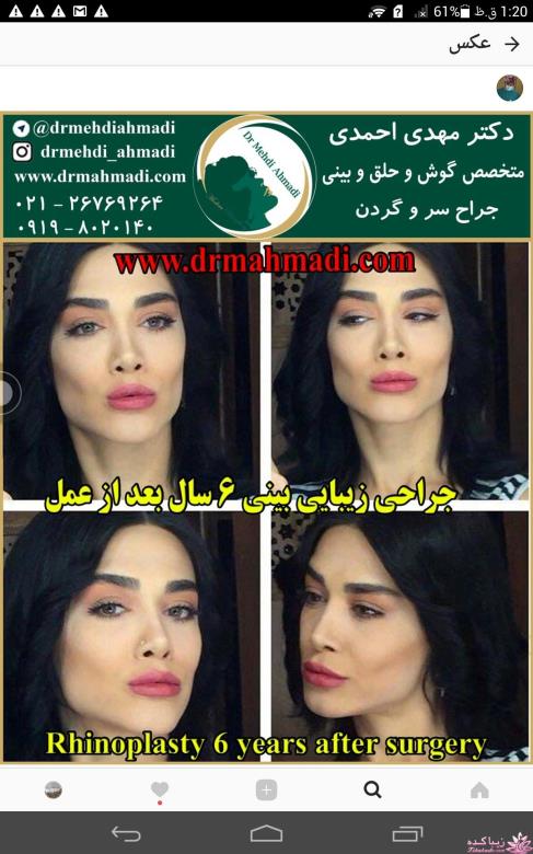 جراحی بینی - جراحی زیبایی