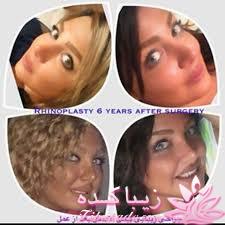 معرفی دکتر برای عمل بینی