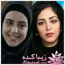 جراحی بینی - جراحی زیبایی