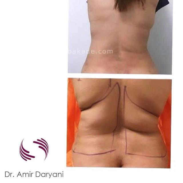 خداحافظی با چربی های شکم و پهلو