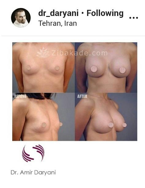 بهترین جراحان لیپوساکشن غب غب شکم پهلو در تهران۰۹۳۰۴۱۷۵۹۰۰
