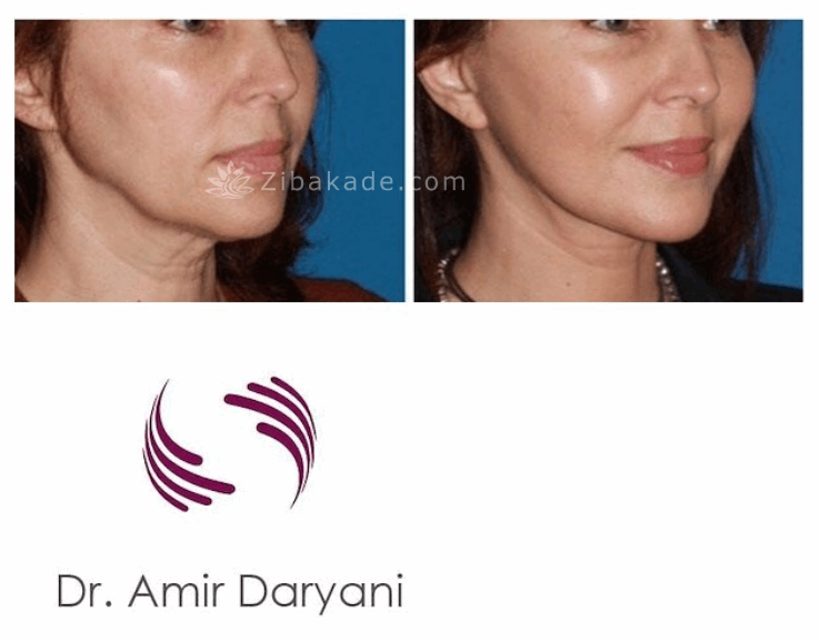 تخفیف جراحی بینی تزریق ژل و بوتاکس پیکر تراشی