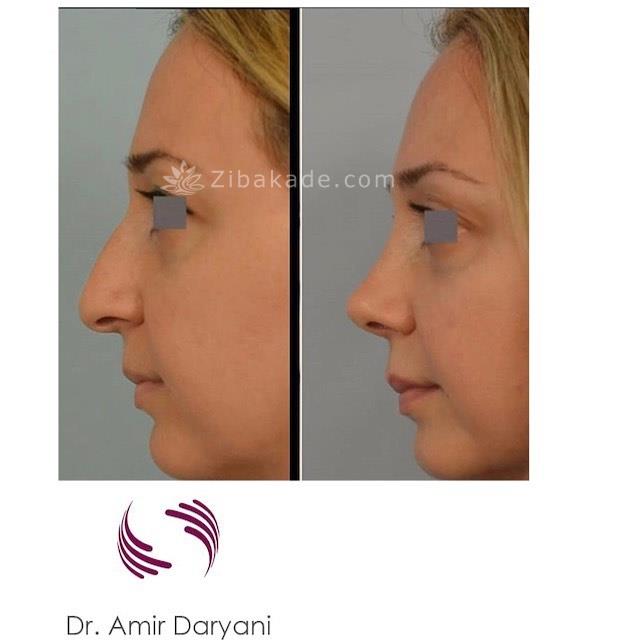 جراحی زیبایی بینی ارزان در بیمارستان دولتی تهران02188856920