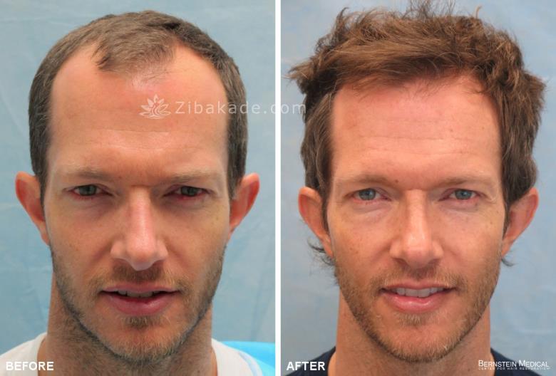 انتخاب بهترین کلینیک کاشت مو