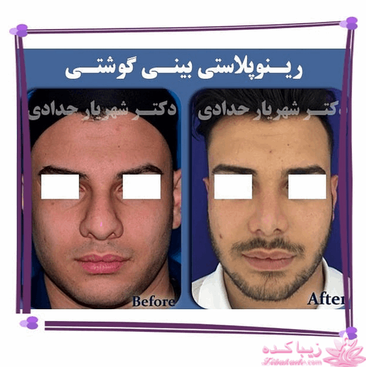 جراحی بینی - جراحی زیبایی