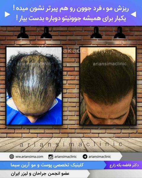 روند کاشت مو چگونه است 