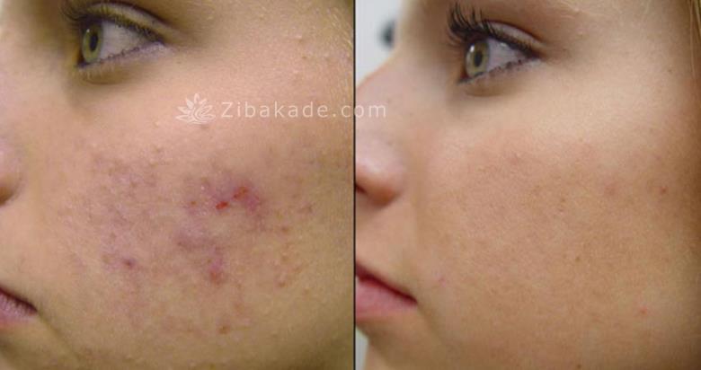 میکرونیدلینگ