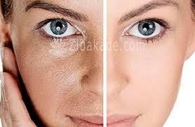 میکرونیدلینگ