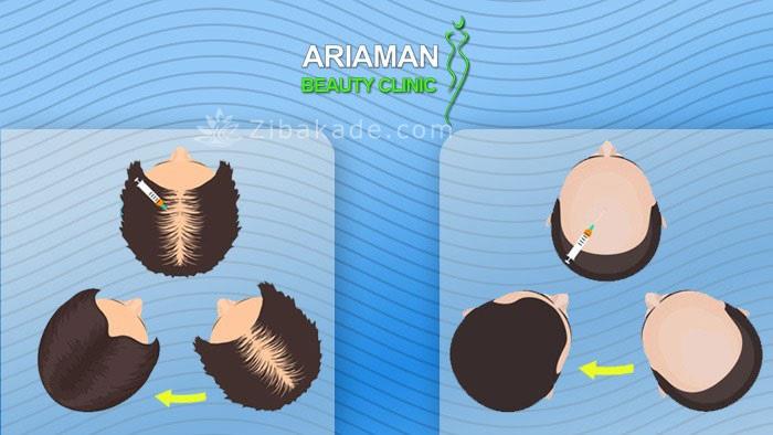 هزینه کاشت مو در ایران چقدر است ؟؟