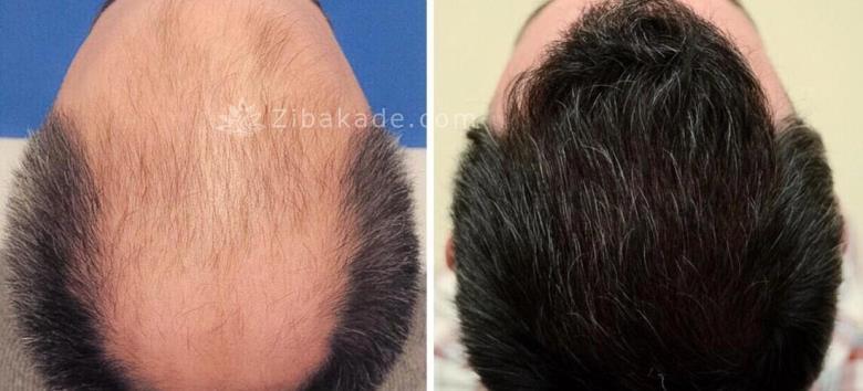 کاشت مو به روش Super fue چگونه است ؟؟؟