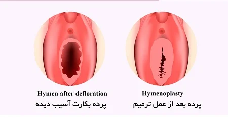 پاره شدن پرده بکارت