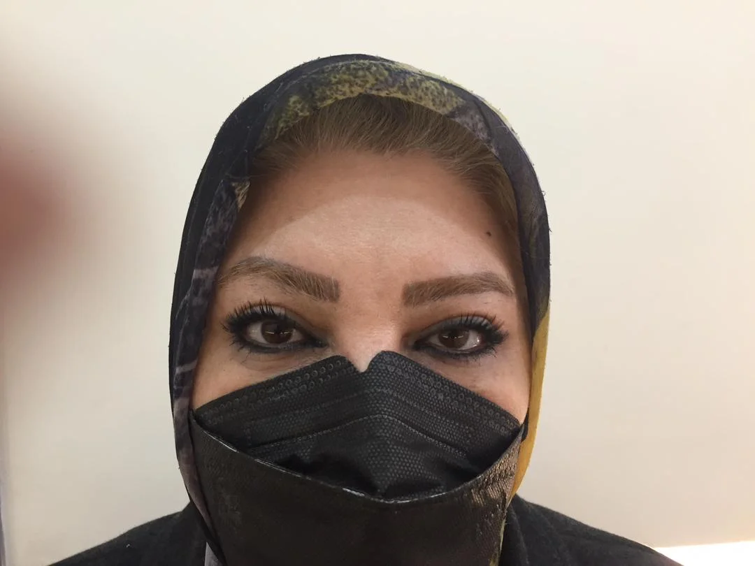 بلفاروپلاستی 