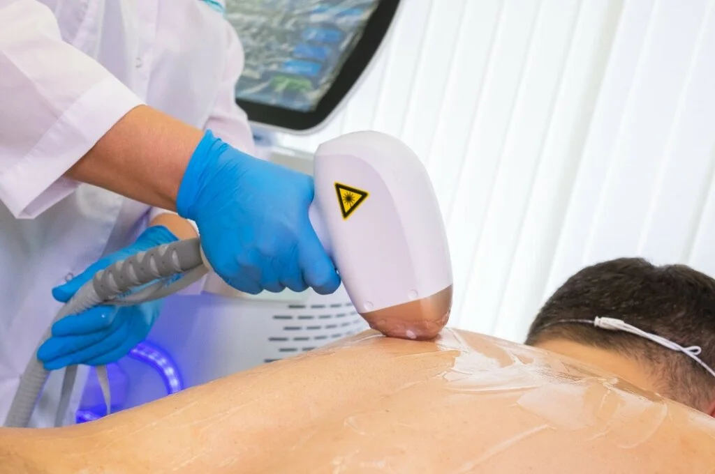 لیزر موهای زائد آقایان برای رفع موهای زیر پوستی