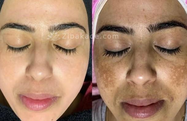 سفیدکننده داعمی پوست و ضد لک قوی بااضمانت مرجوع