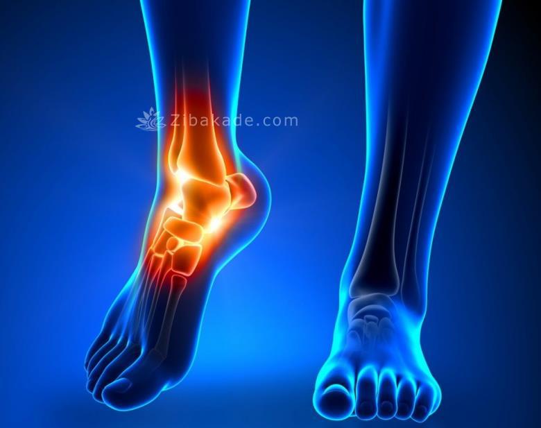 طراحی پروتز مچ پا به چه صورت است؟