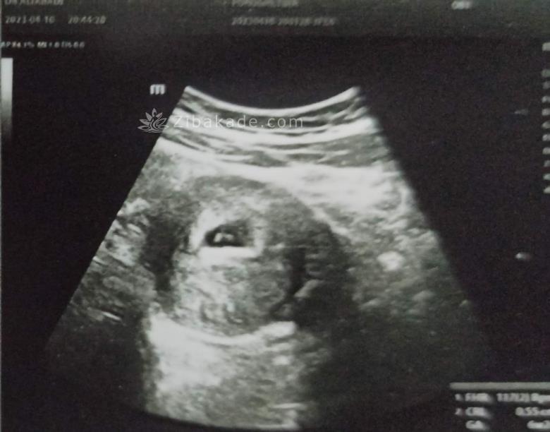 دو قلو یه یکی یه دونه 