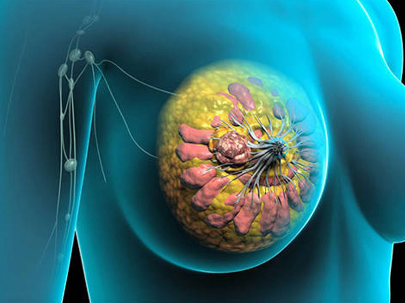 سرطان پستان