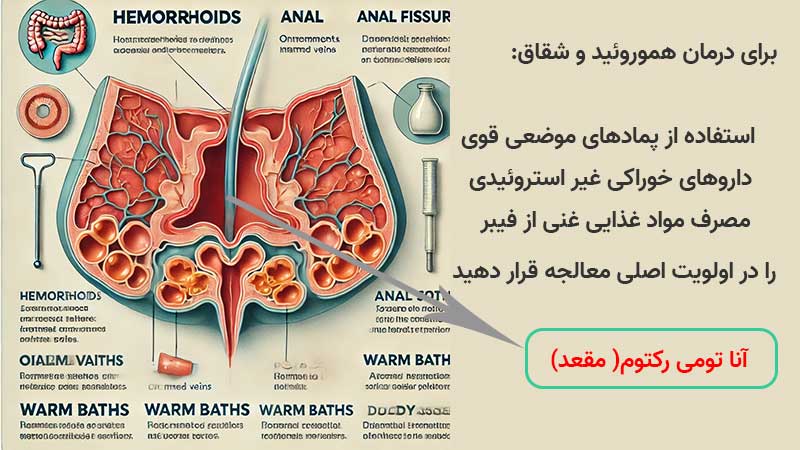 درمان بیماری های مقعدی