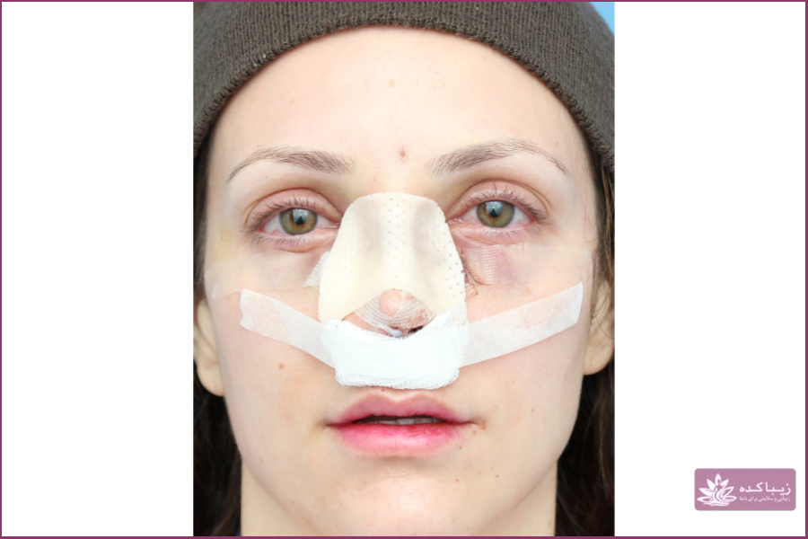 یکی از دلایل گریه بعد رینوپلاستی التهاب و تورم بینی است