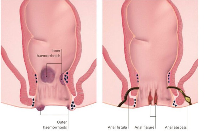 بیماری‌های هموروئید و شقاق مقعدی