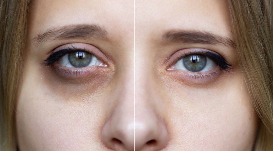 جدیدترین درمان سیاهی دور چشم