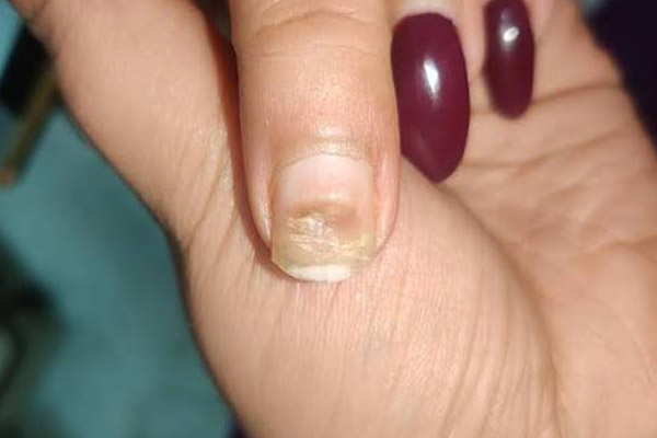 از کجا بفهمیم ناخن بعد از کاشت قارچ گرفته است؟