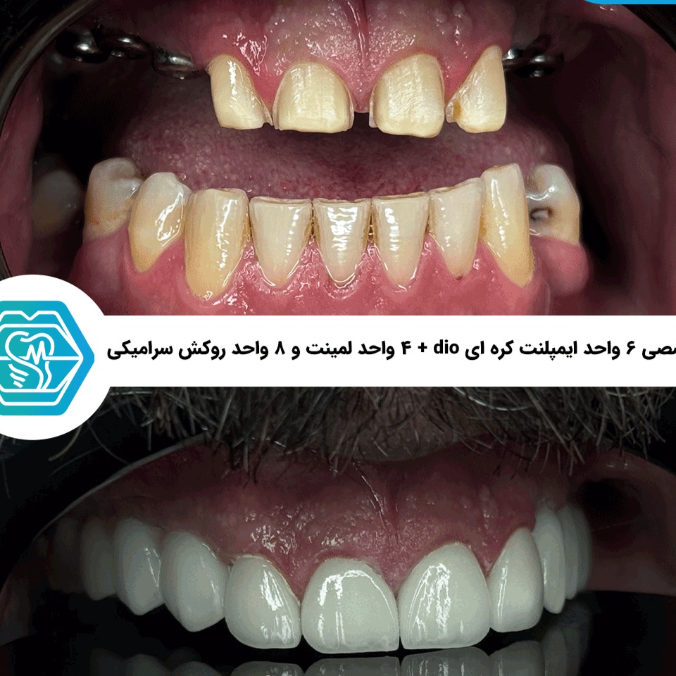 ایمپلنت دیجیتال در شیراز؛ واقعاً چه فرقی با ایمپلنت معمولی دارد؟