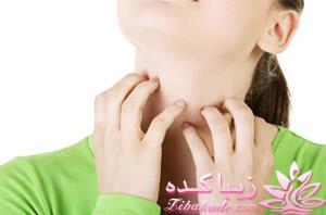 روش های طبیعی برای درمان خارش و حساسیت های پوستی