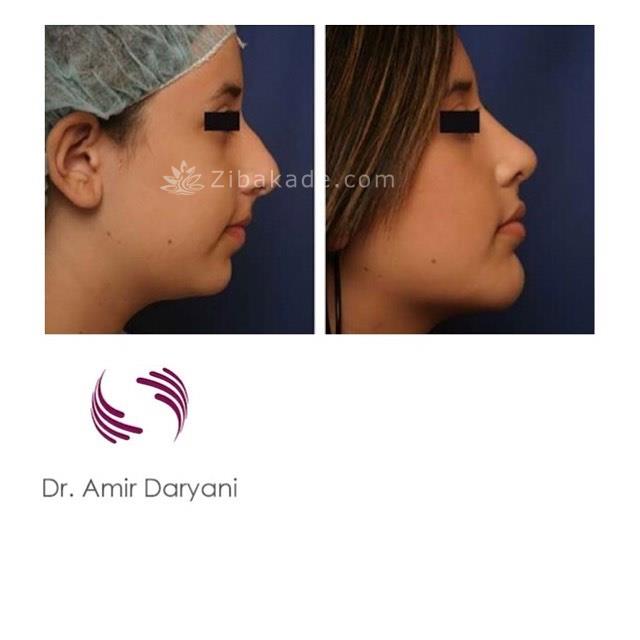 جراحی زیبایی بینی با قیمت 5 ملیون در تهران09304175900